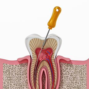 Root Canal Therapy